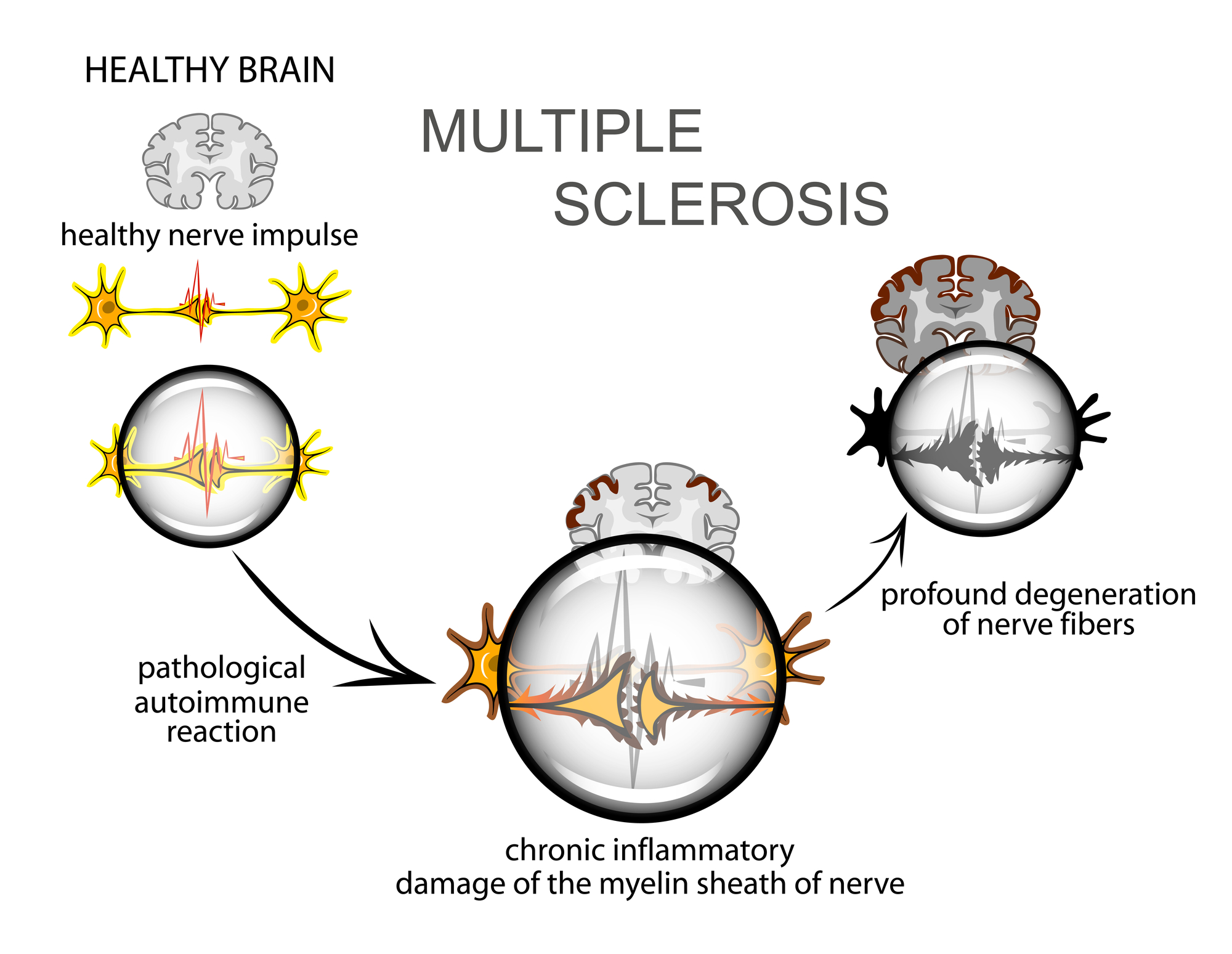 multiple sclerosis diagram